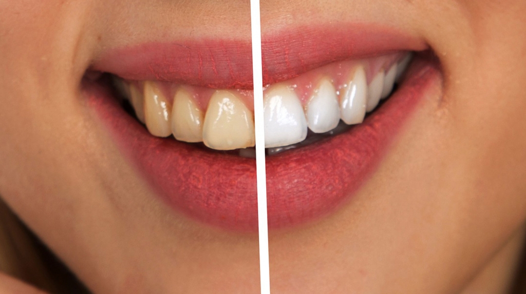 blanqueamiento-dental-laser-la-linea-uniclinic