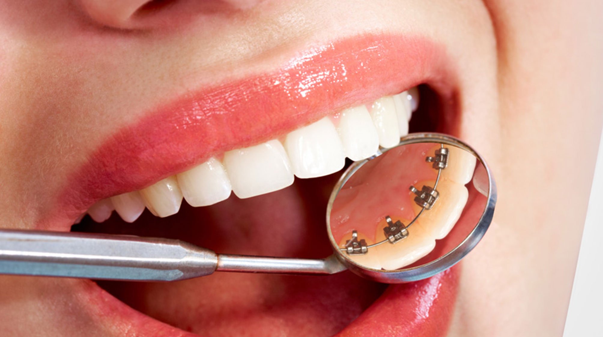 ortodoncia-lingual-la-linea-uniclinic