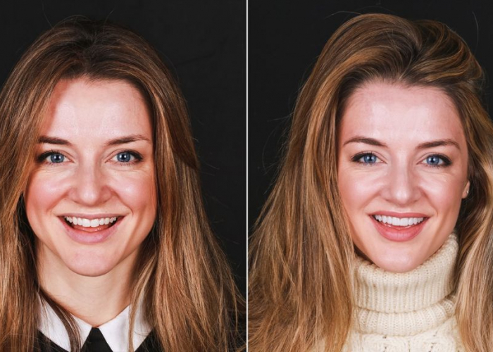 antes-y-despues-carillas-dentales Las carillas dentales sin tallado consiguen el blanqueamiento dental