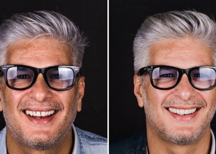 carillas-dentales-diastema Las carillas dentales resuelven problemas de diastema