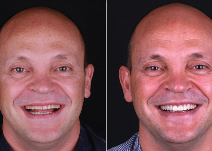 carillas-dentales-nueva-tecnologia Las carillas dentales sin tallado consiguen resultados rápidos