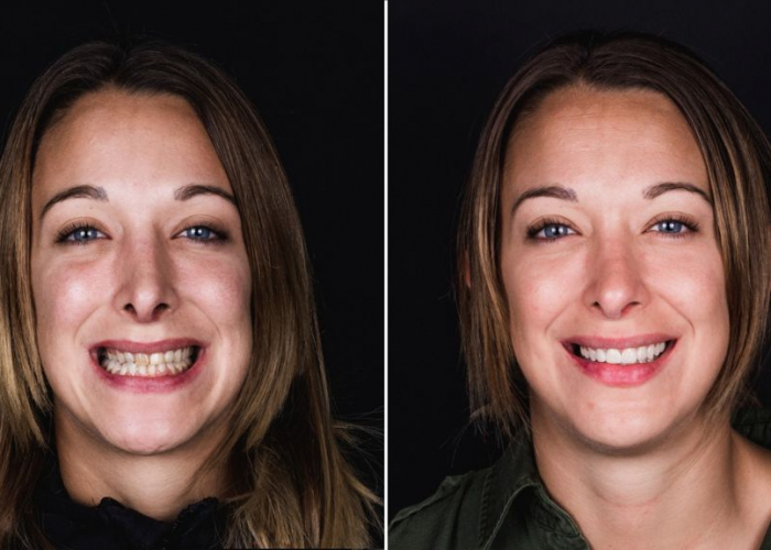 carillas-sin-tallado Las carillas dentales sin tallado corrigen desviaciones en los dientes